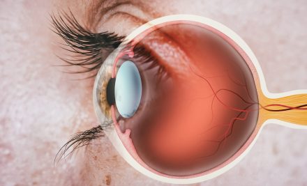 Retina Yırtıkları ve Dekolmanı