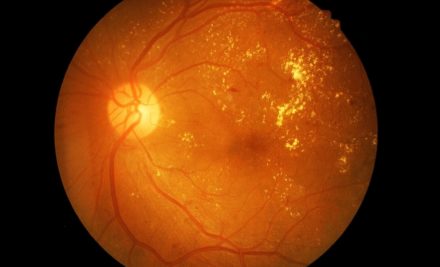 Diyabetik Retinopati